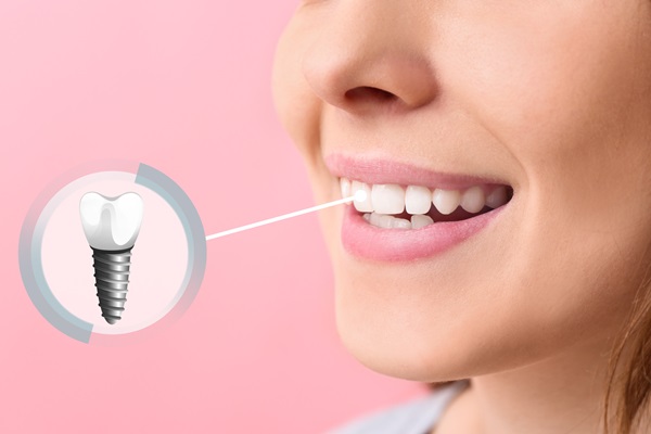 Can A General Dentist Repair A Dental Implant Restoration?